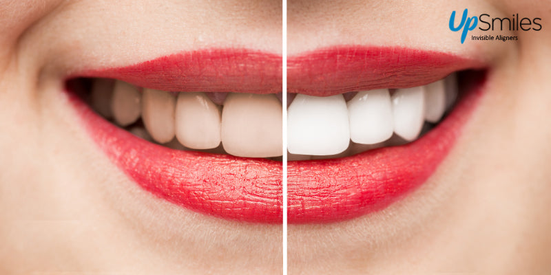 Teeth Whitening Tips To Make Your Smile Brighter