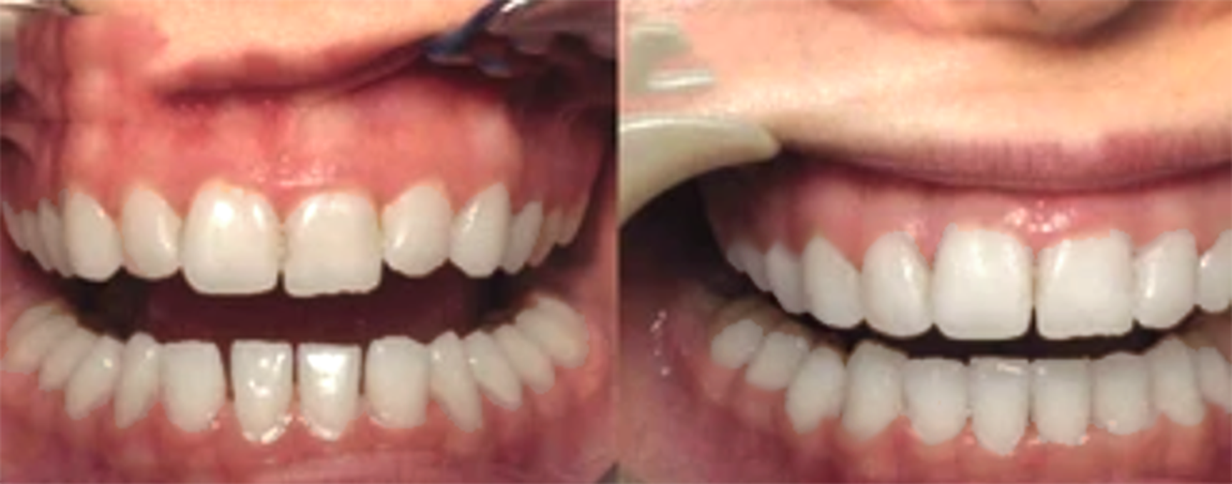 teeth gaps treatment