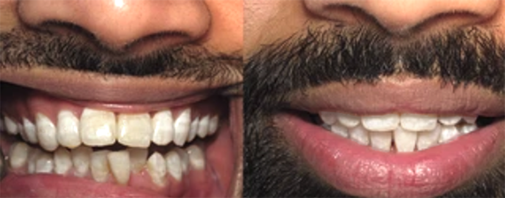 teeth misalignment treatment
