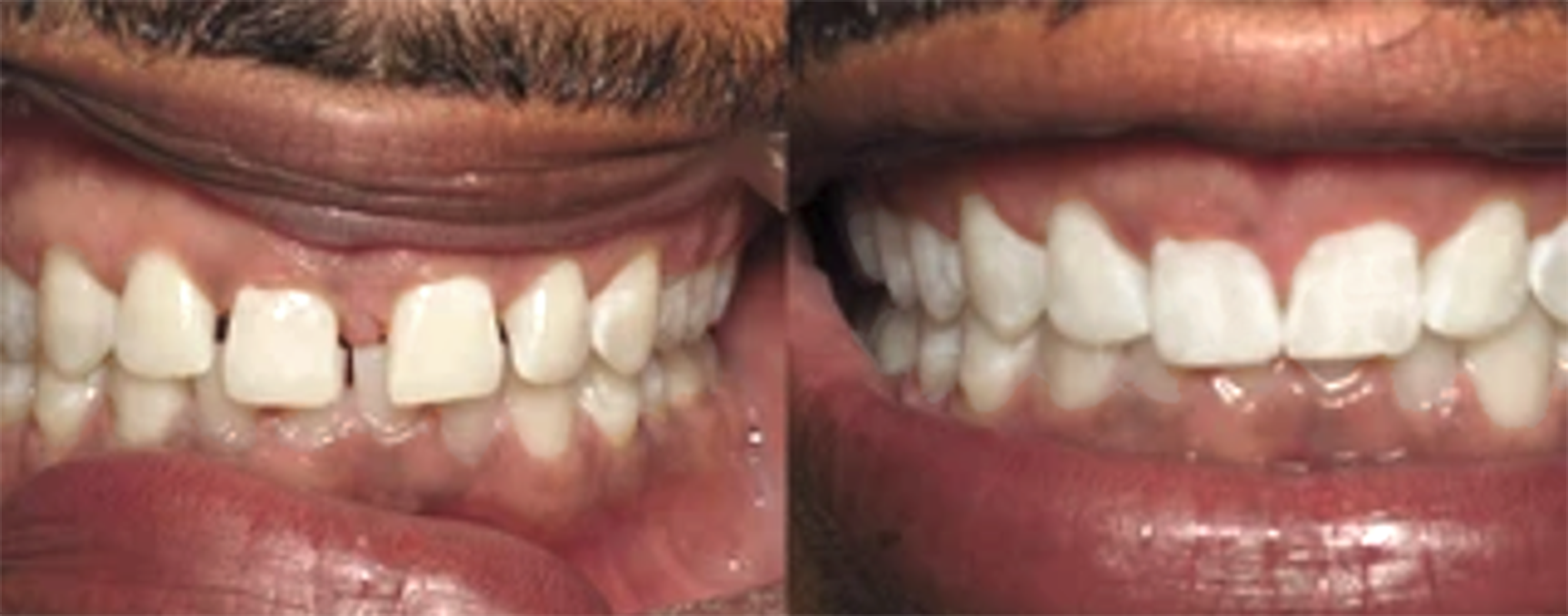 teeth alignment results