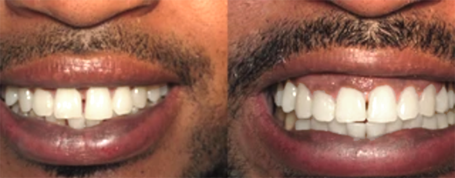 teeth spacing treatment